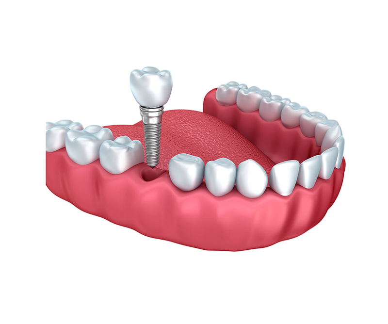 reponer piezas dentales mediante implantes San Sebastián
