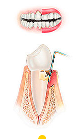 tratar periodontitis moderada en Donostia